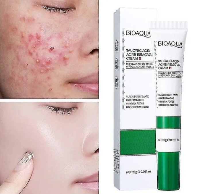 Tratamiento profundo y efectivo contra el acné